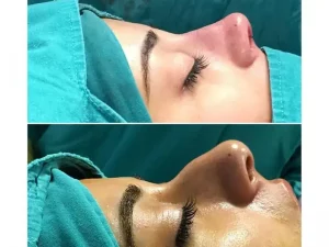 جراحی قوز بینی