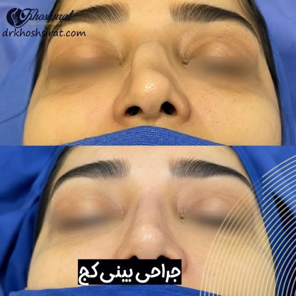 جراحی بینی کج و نامتقارن