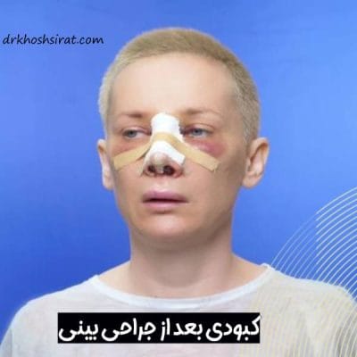 کبودی بعد از عمل بینی