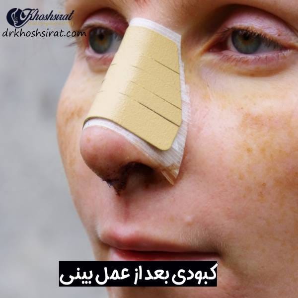کبودی بعد از عمل بینی