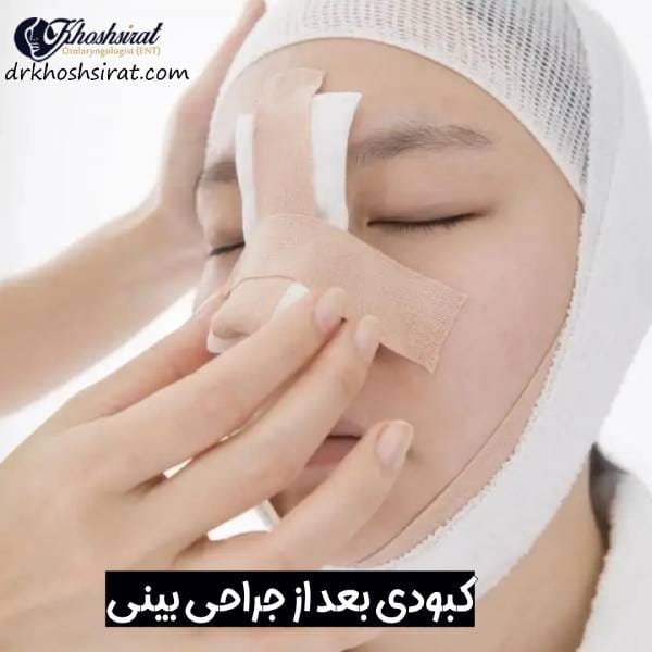 کبودی بعد از جراحی بینی
