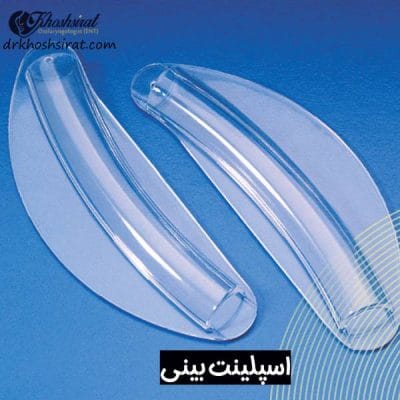 اسپلینت بینی