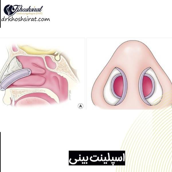اسپلینت داخلی بینی