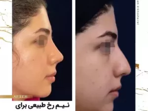 رینوپلاستی در افراد دیابتی
