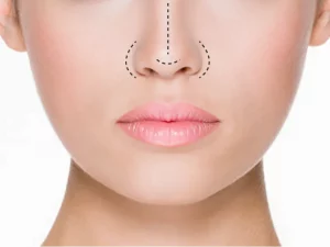 جراحی بینی باز و بسته