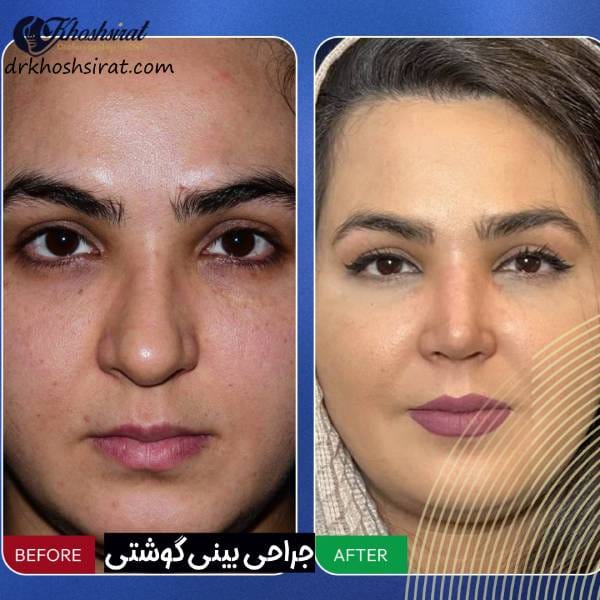 عکی عمل بینی گوشتی