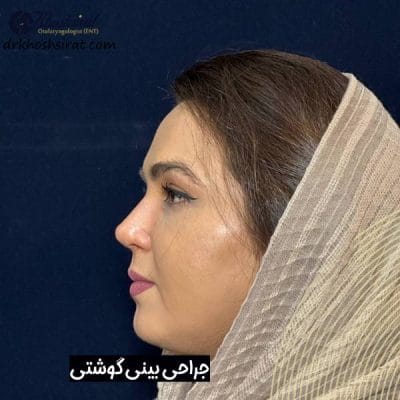 عمل بینی گوشتی