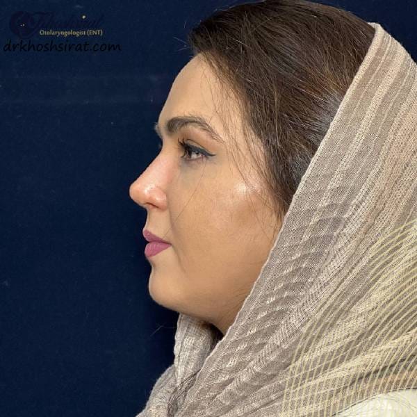 عکس عمل بینی طبیعی