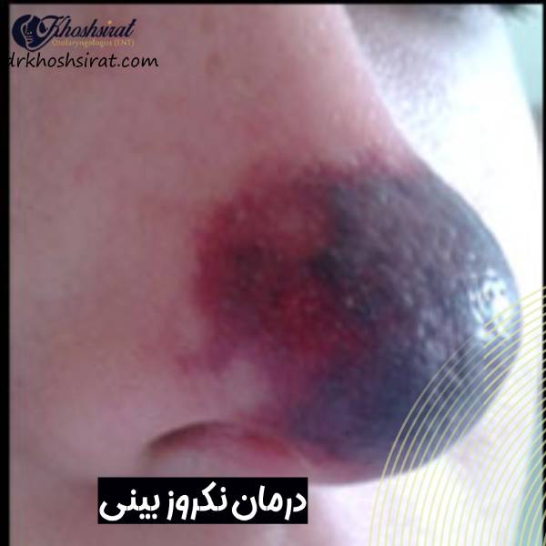 عکس نکروز بینی