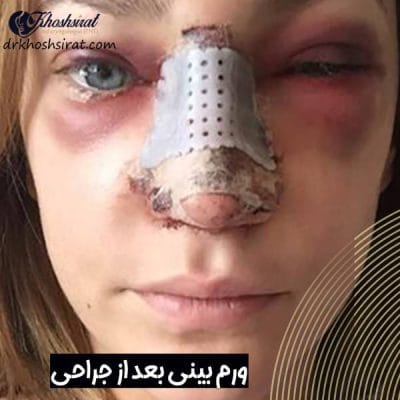 ورم بینی بعد از عمل