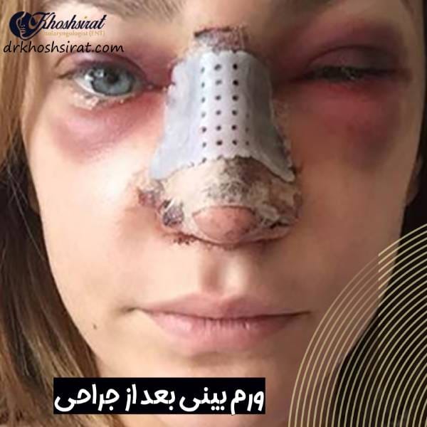 ورم بینی بعد از عمل