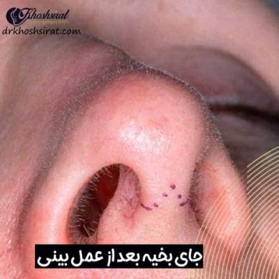 رد بخیه بعد از عمل بینی