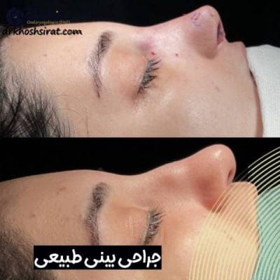 عکس بینی طبیعی عمل شده