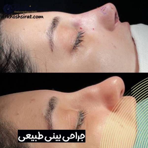 عکس بینی طبیعی عمل شده