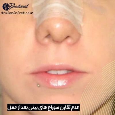 نامتقارن سوراخ های بینی بعد از جراحی