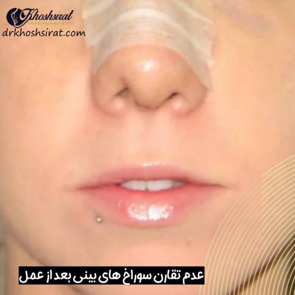 نامتقارن سوراخ های بینی بعد از جراحی