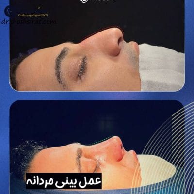 عمل بینی مردانه