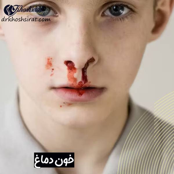 خون دماغ ناگهانی