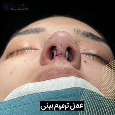 عمل ترمیم بینی