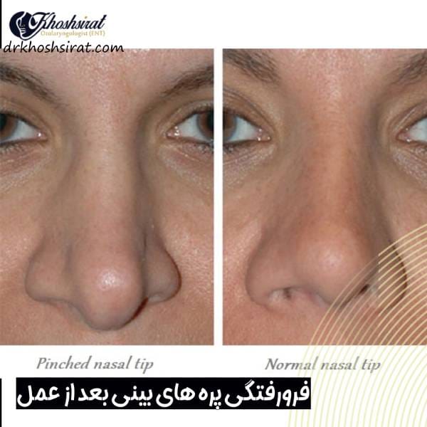 جراحی بینی منگنه ای