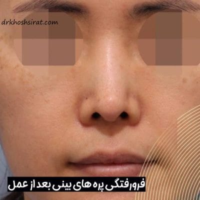 فرو رفتگی بینی بعد از جراحی