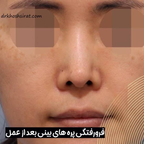 فرو رفتگی بینی بعد از جراحی