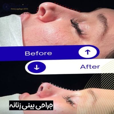جراحی بینی زنانه