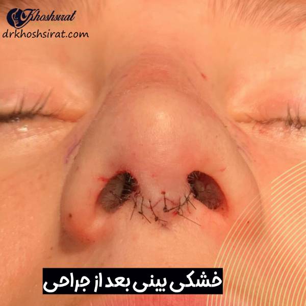 خشکی بینی بعد از عمل