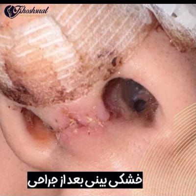 خشکی بینی بعد از عمل