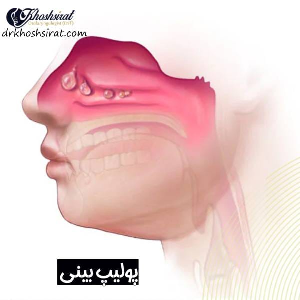 عکس پولیپ بینی