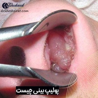 پولیپ بینی