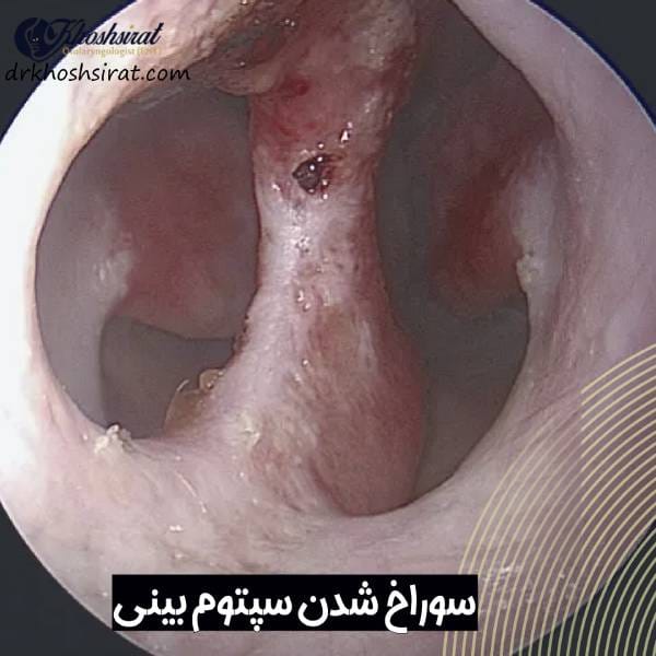 آسیب به تیغه بینی