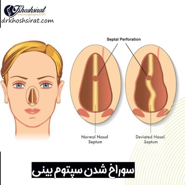 سوراخ شدن تیغه بینی