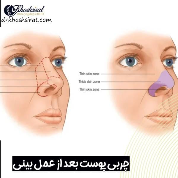 چربی پوست بعد از عمل بینی