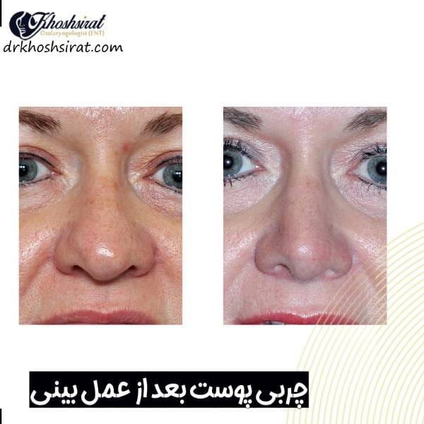 چربی پوست بعد از عمل بینی