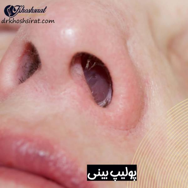 عکس پولیپ بینی