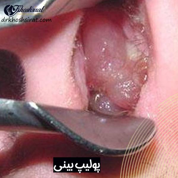 عکس پولیپ بینی