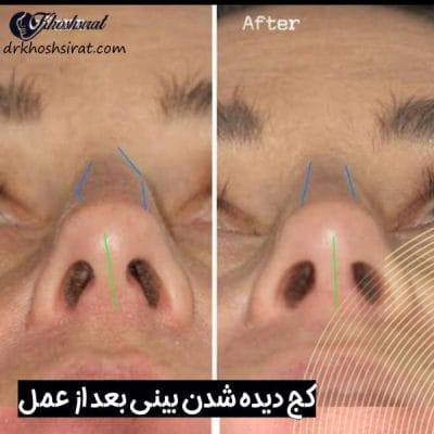 کج دیده شدن بینی بعد از جراحی