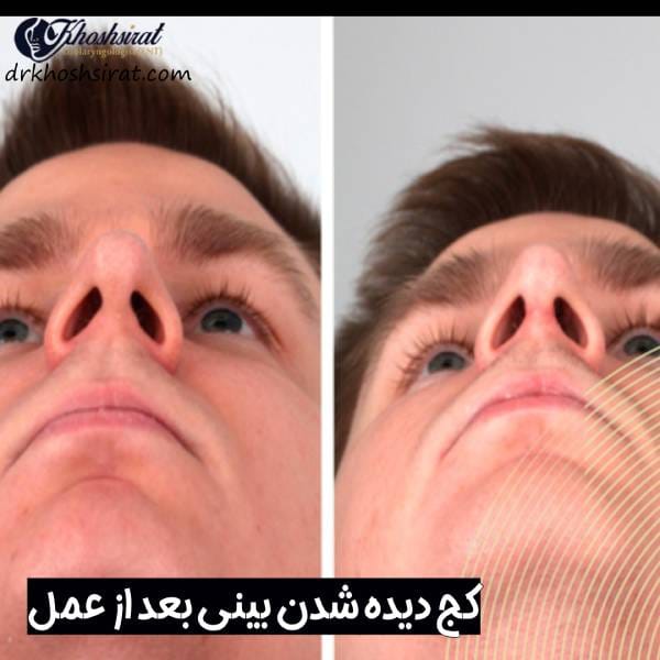 کجی بینی بعد از جراحی