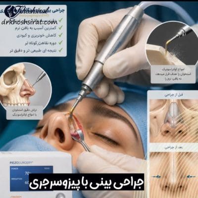 جراحی بینی با پیزوسرجری