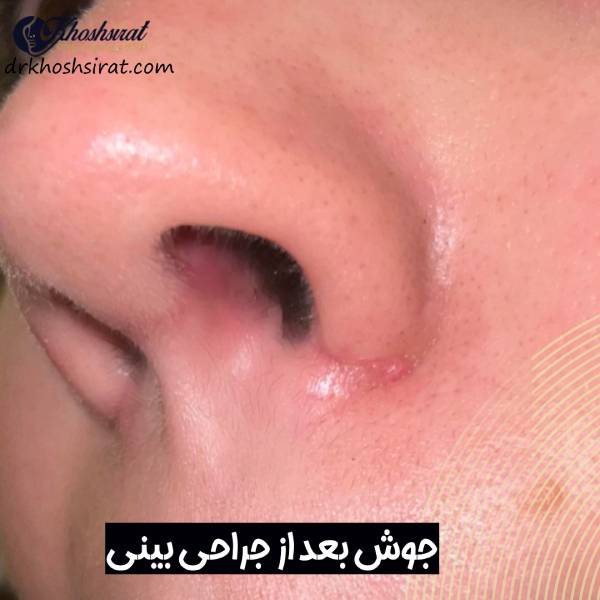 جوش زدن بعد از جراحی بینی
